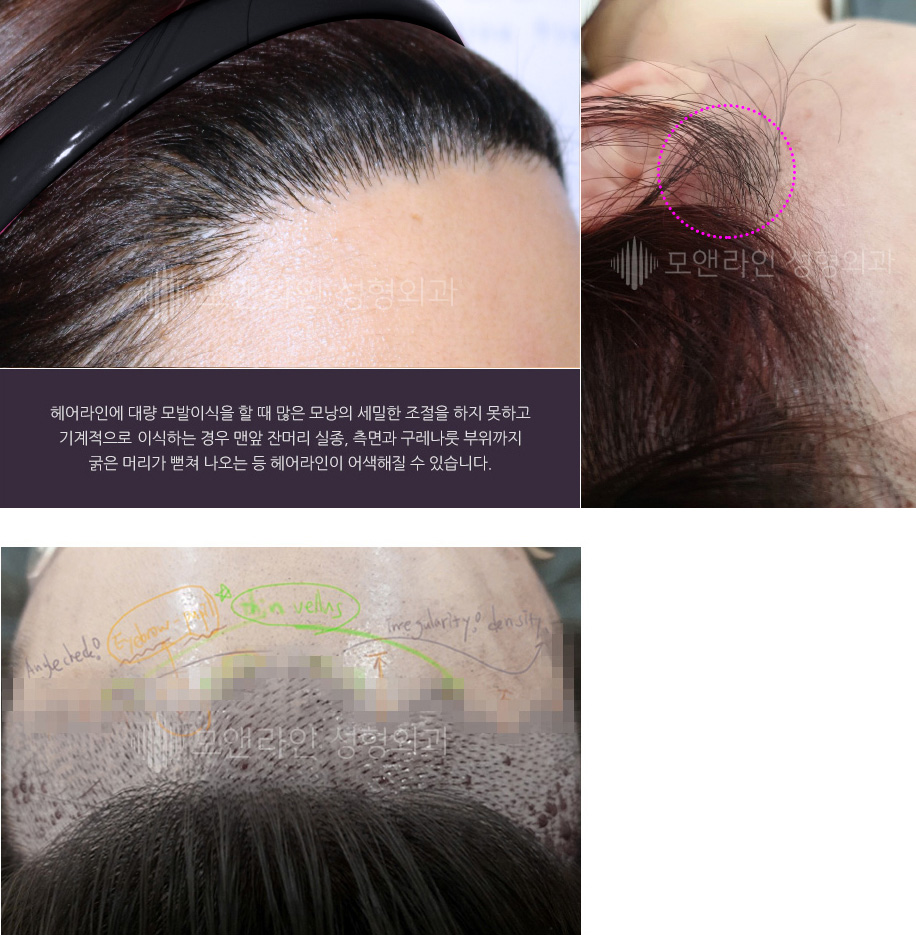 헤어라인에 대량 모발이식을 할 때 많은 모낭의 세밀한 조절을 하지 못하고 기계적으로로 이식하는 경우 맨앞 잔머리 실종, 측면과 구레나룻 부위까지 굵은 머리가 뻗쳐 나오는 등 헤어라인이 어색해질 수 있습니다.