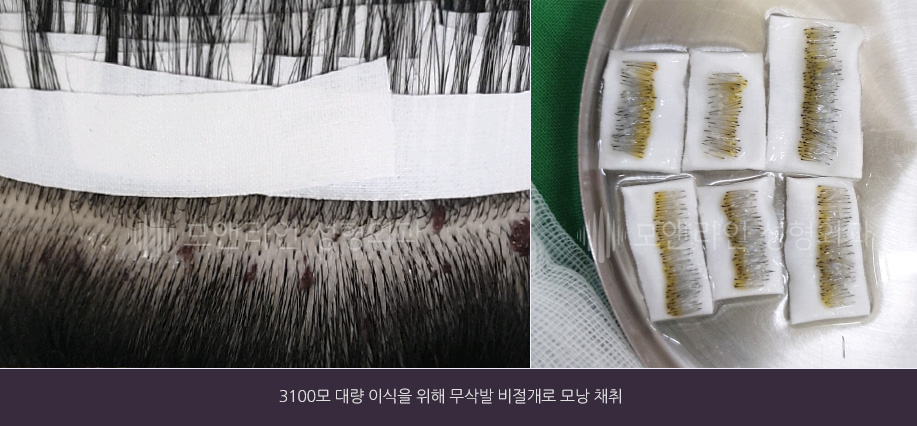 3100모 대량 이식을 위해 무삭발 비절개로 모낭 채취