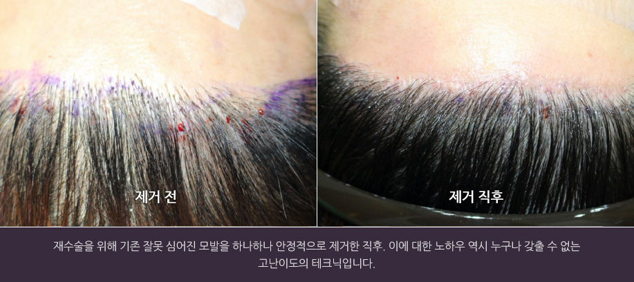 재수술을 위해 기존 잘못 심어진 모발을 하나하나 안정적으로 제거한 직후. 이에 대한 노하우 역시 누구나 갖출 수 없는 고난이도의 테크닉입니다.