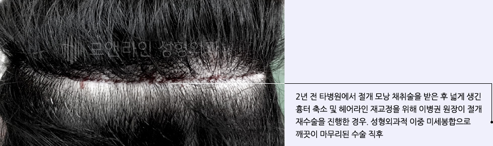 2년 전 타병원에서 절개 모낭 채취술을 받은 후 넓게 생긴 흉터 축소 및 헤어라인 재교정을 위해 이병권 원장이 절개 재수술을 진행한 경우. 성형외과적 이중 미세봉합으로 깨끗이 마무리된 수술 직후