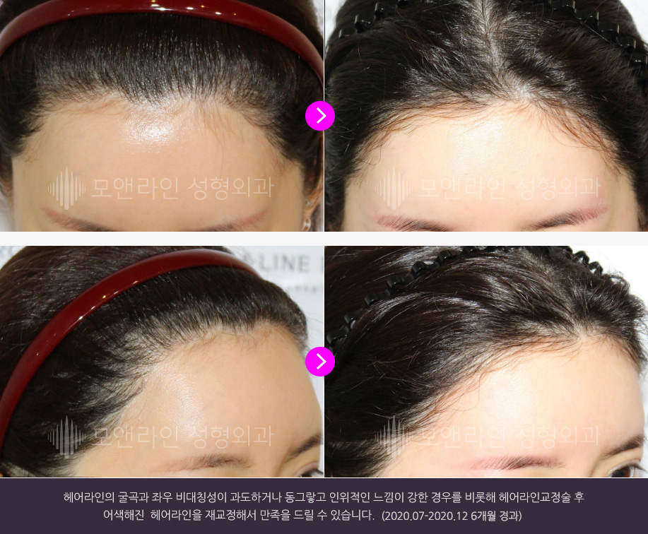 헤어라인의 굴곡과 좌우 비대칭성이 과도하거나 동그랗고 인위적인 느낌이 강한 경우를 비롯해 헤어라인교정술 후 어색해진 헤어라인을 재교정해서 만족을 드릴 수 있습니다.(2020.07-2020.12 6개월 경과)