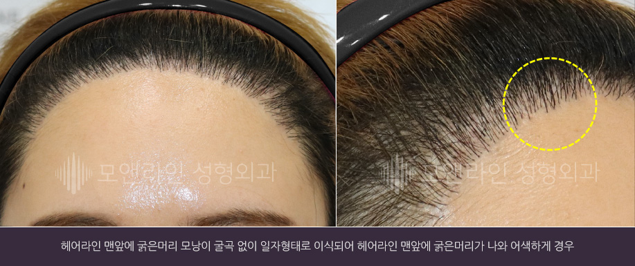 헤어라인 맨앞에 굵은머리 모낭이 굴곡 없이 일자형태로 이식되어 헤어라인 맨앞에 굵은머리가 나와 어색하게 경우