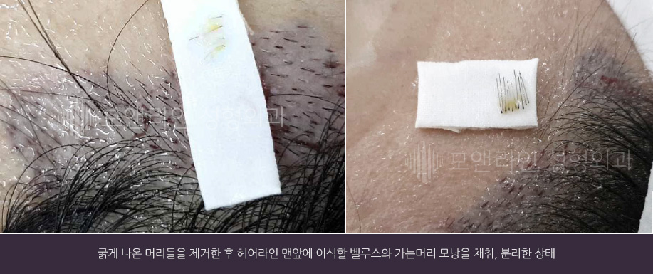 굵게 나온 머리들을 제거한 후 헤어라인 맨앞에 이식할 벨루스와 가는머리 모낭을 채취, 분리한 상태