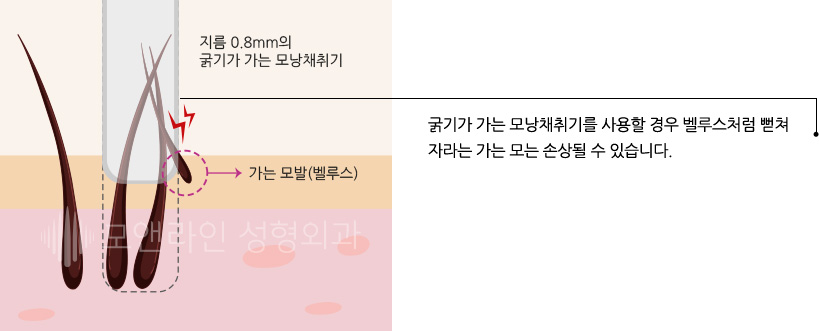 굵기가 가는 모낭채취기를 사용할 경우 벨루스처럼 뻗쳐 자라는 가는 모는 손상될 수 있습니다.