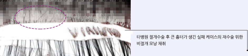 타병원 절개수술 후 큰 흉터가 생긴 실패 케이스의 재수술 위한 비절개 모낭 채취