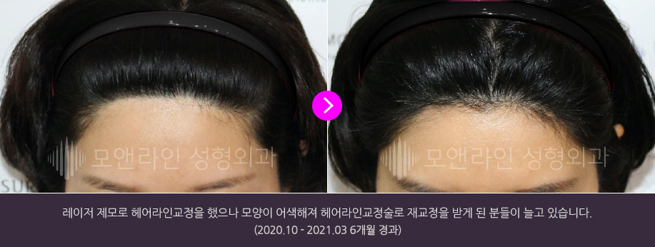레이저 제모로 헤어라인교정을 했으나 모양이 어색해져 헤어라인교정술로 재교정을 받게 된 분들이 늘고 있습니다.(2020.10 - 2021.03 6개월 경과)