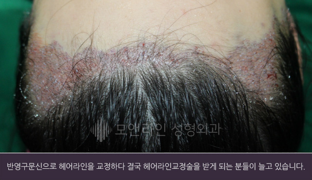 반영구문신으로 헤어라인을 교정하다 결국 헤어라인교정술을 받게 되는 분들이 늘고 있습니다.