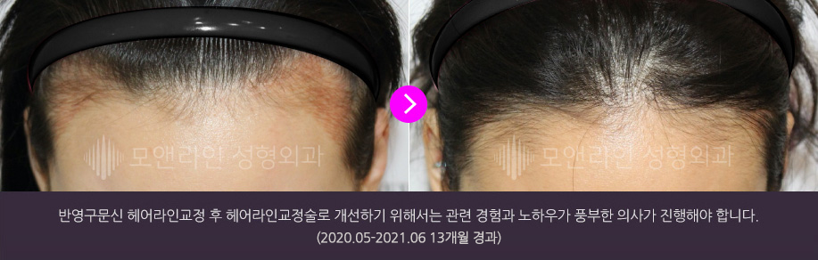 반영구문신 헤어라인교정 후 헤어라인교정술로 개선하기 위해서는 관련 경험과 노하우가 풍부한 의사가 진행해야 합니다.(2020.05-2021.06 13개월 경과)