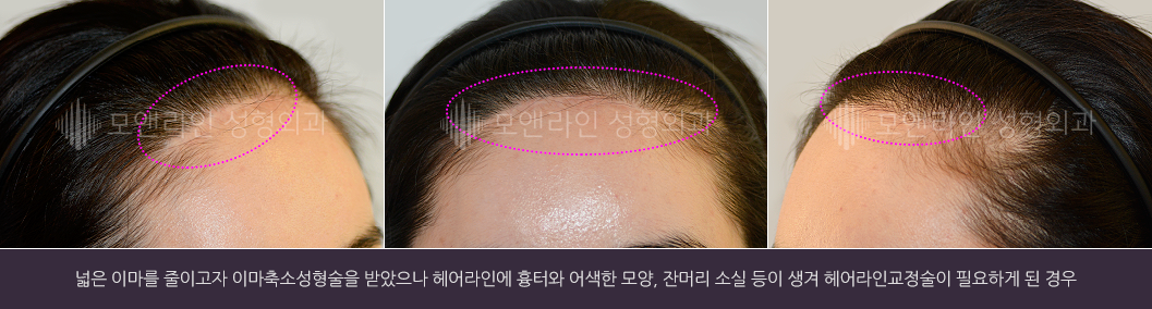 넓은 이마를 줄이고자 이마축소성형술을 받았으나 헤어라인에 흉터와 어색한 모양, 잔머리 소실 등이 생겨 헤어라인교정술이 필요하게 된 경우