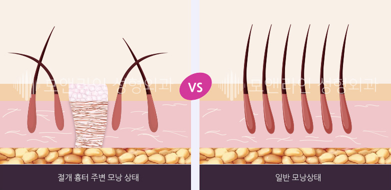 절개 흉터 주변 모낭 상태 VS 일반 모낭상태