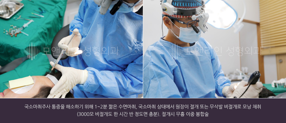 국소마취주사 통증을 해소하기 위해 1~2분 짦은 수면마취, 국소마취 상태에서 원장이 절개 또는 무삭발 비절개로 모낭 채취(3000모 비절개도 한 시간 반 정도면 충분). 절개시 무흉 이중 봉합술