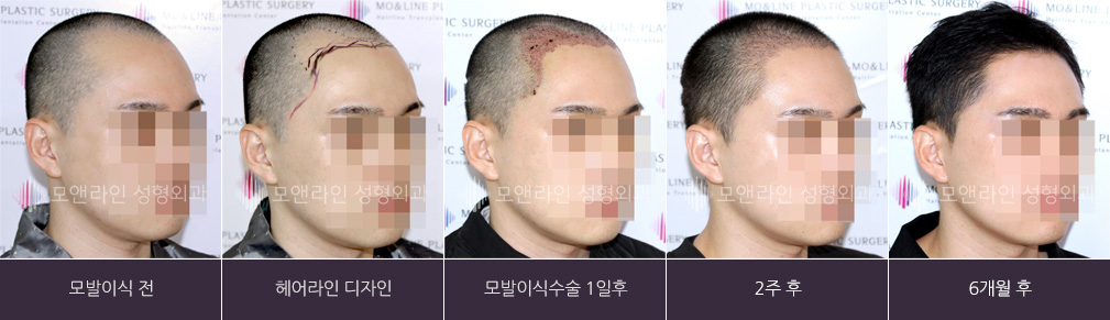 모발이식 전 / 헤어라인 디자인 / 모발이식수술 1일 후 / 2주 후 / 6개월 후