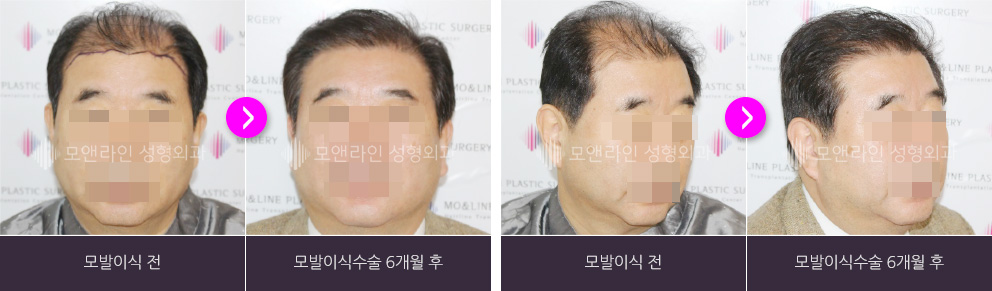정면 사진 : 모발이식 전 > 모발이식수술 6개월 후 / 측면 사진 : 모발이식 전 > 모발이식수술 6개월 후