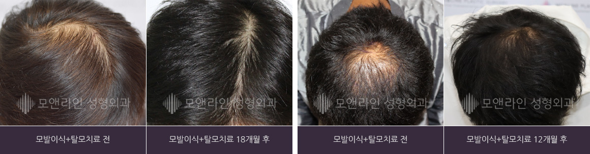 측면 사진 : 모발이식+탈모치료 전 > 모발이식+탈모치료 18개월 후 / 정수리 사진 : 모발이식+탈모치료 전 > 모발이식+탈모치료 12개월 후
