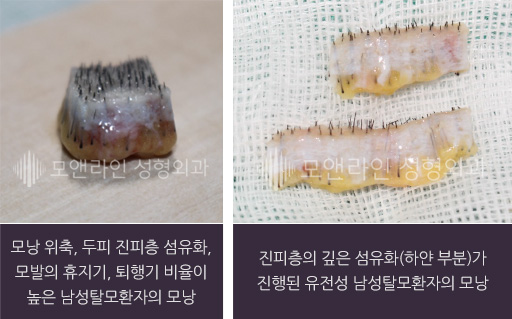 좌측 사진 : 모낭 위축, 두피 진피층 섬유화, 모발의 휴지기, 퇴행기 비율이 높은 남성탈모환자의 모낭 / 우측 사진 : 진피층의 깊은 섬유화(하얀 부분)가 진행된 유전성 남성탈모환자의 모낭