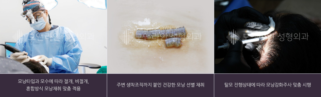 모낭타입과 모수에 따라 절개, 비절개, 혼합방식 모낭채취 맞춤 적용 / 주변 생착조직까지 붙인 건강한 모낭 선별 채취 / 탈모 진행상태에 따라 모낭강화주사 맞춤 시행