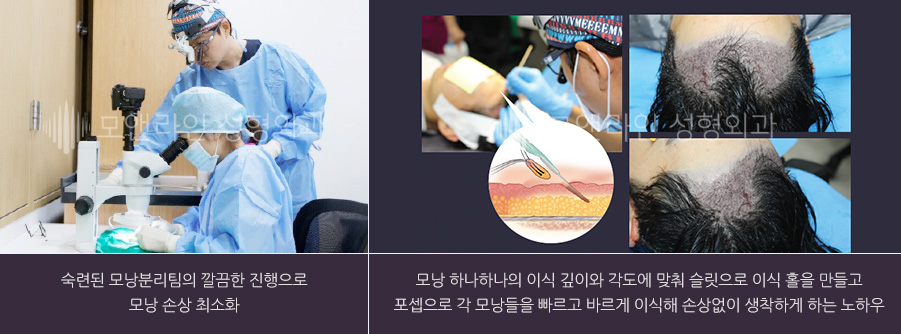 숙련된 모낭분리팀의 깔끔한 진행으로 모낭 손상 최소화 / 모낭 하나하나의 이식 깊이와 각도에 맞춰 슬릿으로 이식 홀을 만들고 포셉으로 각 모낭들을 빠르고 바르게 이식해 손상없이 생착하게 하는 노하우