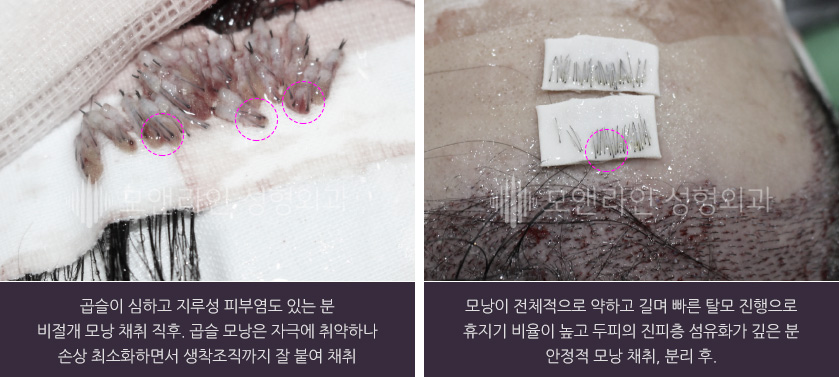 좌측 사진 : 곱슬이 심하고 지루성 피부염도 있는 분. 비절개 모낭 채취 직후. 곱슬 모낭은 자극에 취약하나 손상 최소화하면서 생착조직까지 잘 붙여 채취 / 우측 사진 : 모낭이 전체적으로 약하고 길며 빠른 탈모 진행으로 휴지기 비율이 높고 두피의 진피층 섬유화가 깊은 분. 안정적 모낭 채취, 분리 후.