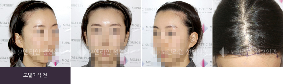 모발이식 전 사진