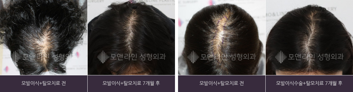 좌측 사진 : 모발이식+탈모치료 전 | 모발이식+탈모치료 7개월 후 / 우측 사진 : 모발이식+탈모치료 전 | 모발이식수술+탈모치료 7개월 후