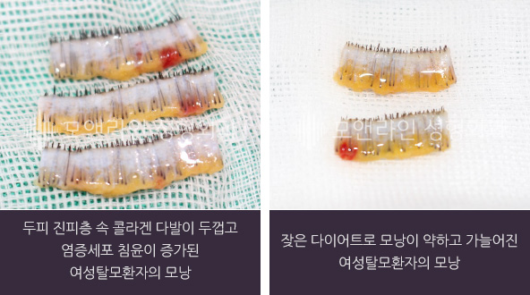 좌측 사진 : 두피 진피층 속 콜라겐 다발이 두껍고 염증세포 침윤이 증가된 여성탈모환자의 모낭 / 우측 사진 : 잦은 다이어트로 모낭이 약하고 가늘어진 여성탈모환자의 모낭