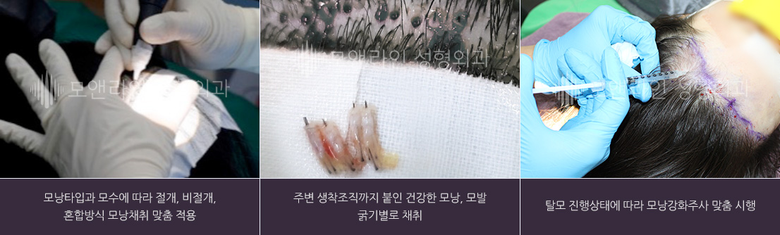 모낭타입과 모수에 따라 절개, 비절개, 혼합방식 모낭채취 맞춤 적용 / 주변 생착조직까지 붙인 건강한 모낭 선별 채취 / 탈모 진행상태에 따라 모낭강화주사 맞춤 시행