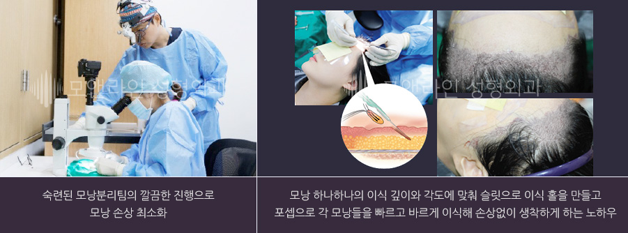 숙련된 모낭분리팀의 깔끔한 진행으로 모낭 손상 최소화 / 모낭 하나하나의 이식 깊이와 각도에 맞춰 슬릿으로 이식 홀을 만들고 포셉으로 각 모낭들을 빠르고 바르게 이식해 손상없이 생착하게 하는 노하우
