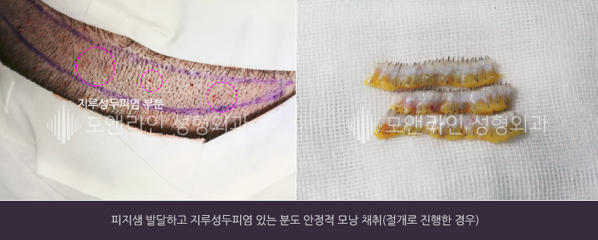 피지샘 발달하고 지루성두피염 있는 분도 안정적 모낭 채취(절개로 진행한 경우)