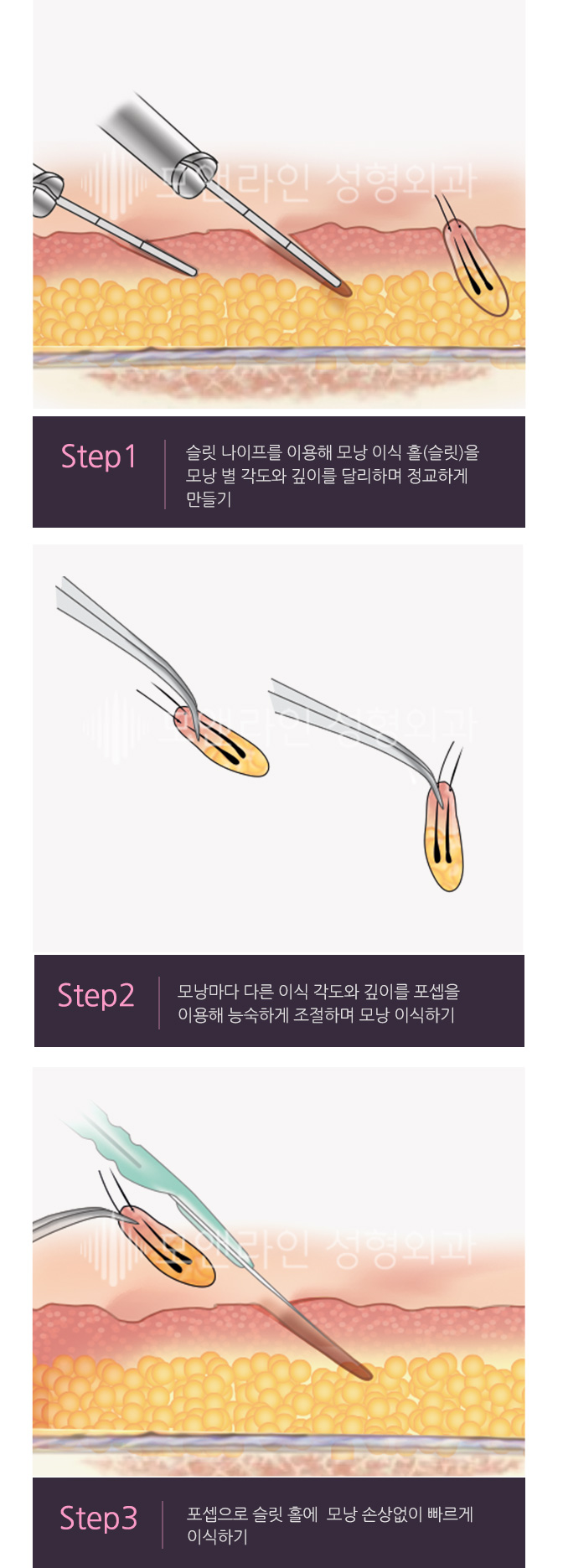 Step1. 슬릿 나이프를 이용해 모낭 이식 홀(슬릿)을 모낭 별 각도와 깊이를 달리하며 정교하게 만들기 / Step2. 모낭마다 다른 이식 각도와 깊이를 포셉을 이용해 능숙하게 조절하며 모낭 이식하기 / Step3. 포셉으로 슬릿 홀에 모낭 손상없이 빠르게 이식하기