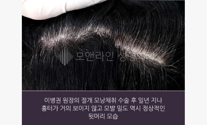 이병권 원장의 절개 모낭채취 수술 후 일년 지나 흉터가 거의 보이지 않고 모발 밀도 역시 정상적인 뒷머리 모습.