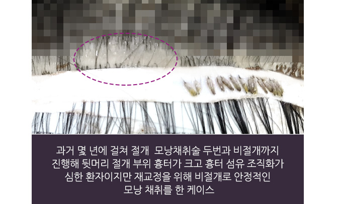 과거 몇 년에 걸쳐 절개 모낭채취술 두번과 비절개까지 진행해 뒷머리 절개 부위 흉터가 크고 흉터 섬유 조직화가 심한 환자이지만 재교정을 위해 비절개로 안정적인 모낭 채취를 한 케이스
