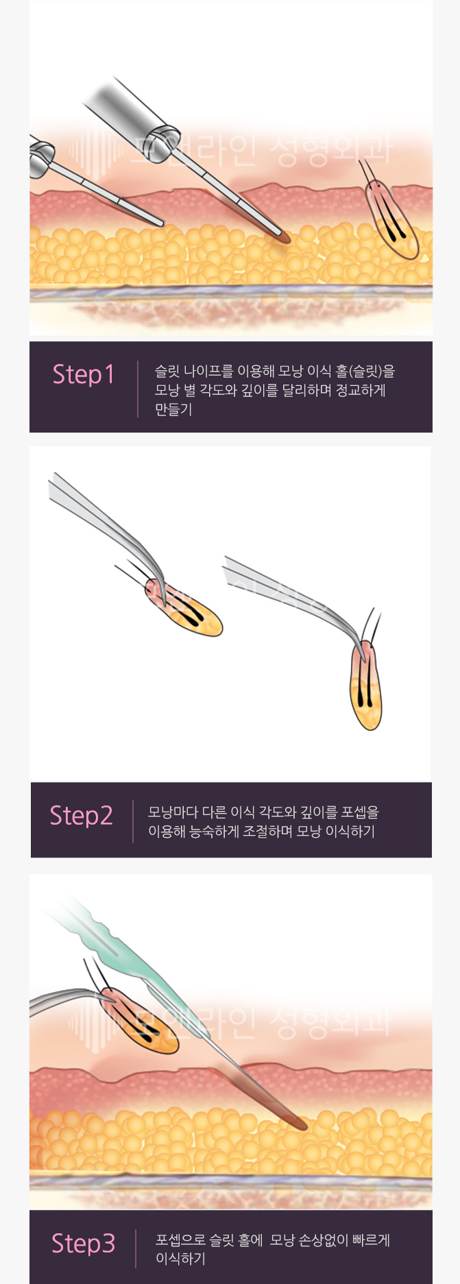 Step1. 슬릿 나이프를 이용해 모낭 이식 홀(슬릿)을 모낭 별 각도와 깊이를 달리하며 정교하게 만들기 > Step2. 모낭마다 다른 이식 각도와 깊이를 포셉을 이용해 능숙하게 조절하며 모낭 이식하기 > Step3. 포셉으로 슬릿 홀에 모낭 손상없이 빠르게 이식하기