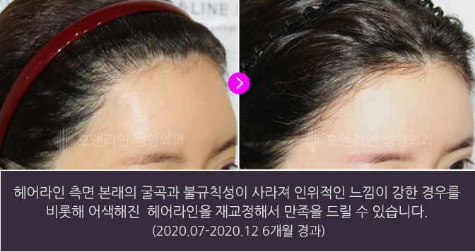 헤어라인 측면 본래의 굴곡과 불규칙성이 사라져 인위적인 느낌이 강한 경우를 비롯해 어색해진 헤어라인을 재교정해서 만족을 드릴 수 있습니다.(2020.07-2020.12 6개월 경과)