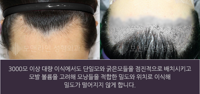 3000모 이상 대량 이식에서도 단일모와 굵은모들을 점진적으로 배치시키고 모발 볼륨을 고려해 모낭들을 적합한 밀도와 위치로 이식해 밀도가 떨어지지 않게 합니다.