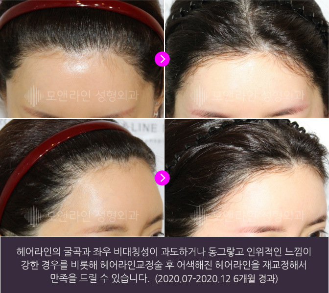 헤어라인의 굴곡과 좌우 비대칭성이 과도하거나 동그랗고 인위적인 느낌이 강한 경우를 비롯해 헤어라인교정술 후 어색해진 헤어라인을 재교정해서 만족을 드릴 수 있습니다.(2020.07-2020.12 6개월 경과)