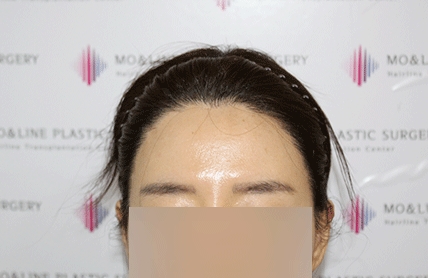 치료후기 이미지